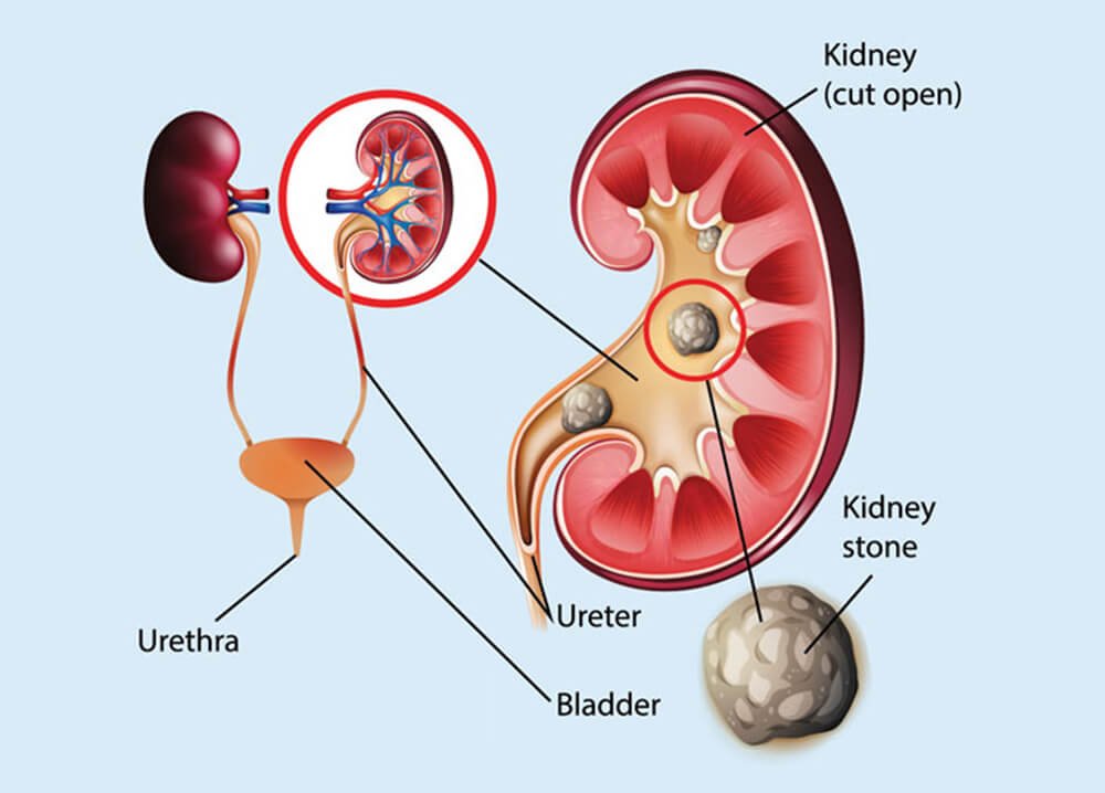Kidney Stone Treatment